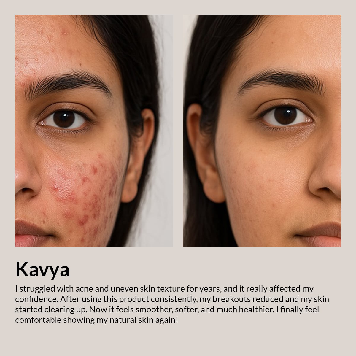 Camel Milk Anti-Acne Night Cream with Salicyclic acid + Niacinamide 4%