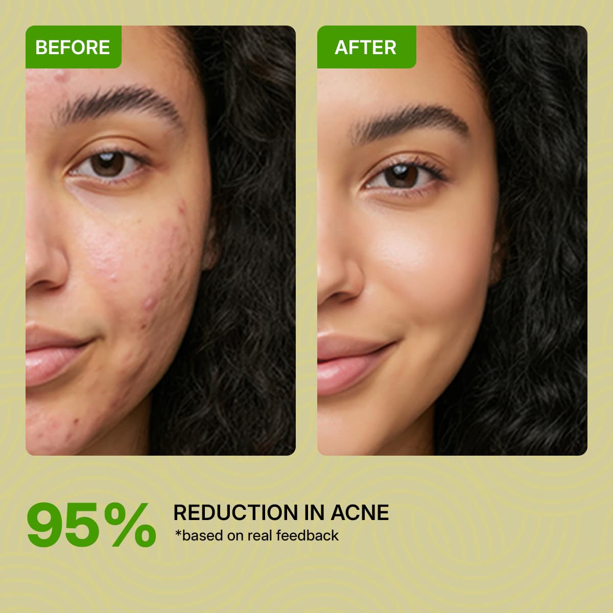 Camel Milk Anti-Acne Serum with  Salicylic Acid + Niacinamide  4%- Face Serum